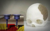 3D打印技术成功用于颅骨移植