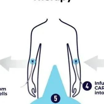 百年细胞治疗史，CAR-T未来如何突破？
