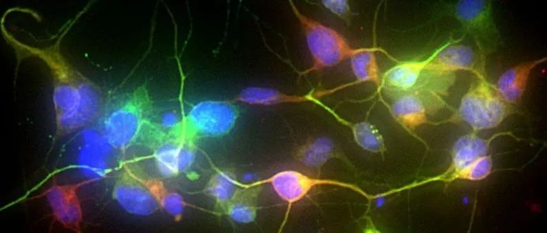 皮肤细胞成功转化为神经元！这对神经元丧失的帕金森病患者意味着什么？