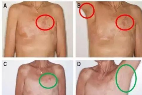如何提高三阴性乳腺癌患者的生存率？
