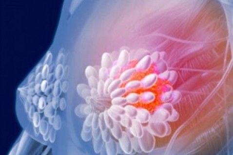 乳腺癌复发怎么办？新疗法有望控制乳腺癌复发
