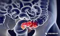 复旦大学肿瘤医院发表直肠癌重磅研究：将为两类患者带来希望，他们也许可
