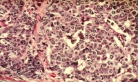 PNAS：纳米粒子助力CRISPR，三阴性乳腺癌小鼠肿瘤生长减缓77%