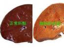 J Hepatol：脂肪肝，到底需要多少运动量？
