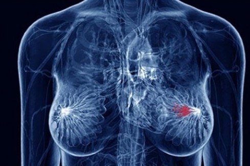 乳腺癌稳居女性第一大癌，做到这些能帮你尽量避免！