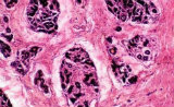 浙大科学家发现已获批糖尿病药物或可以治疗致命性乳腺癌