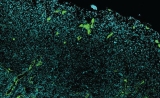 惊人发现！Science子刊：癌症“帮凶”竟让免疫疗法更强