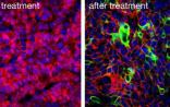 Cancer Research：科学家发现攻克癌症干细胞的新药