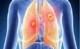 【肿瘤前沿】ASCO发布基于基因检测的最新NSCLC治疗指南，赶紧看看更新了哪些内