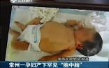 解读：常州孕妇产下胎中胎 概率仅为百万分之一