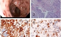 浙大江米足教授在消化TOP期刊Gastroenterology上发表高质量临床研究论文