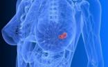 深圳建乳腺肿瘤诊疗研究中心