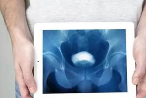 担心前列腺癌转移？这种检测方法效率更快、费用更便宜