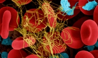 Science关注：最“安全”基因治疗载体似乎并不安全，血友病患者接受治疗后患