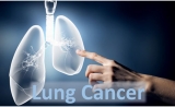 晚期肺癌怎么治？肺癌精准诊疗新模式