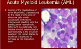 美国医讯：《Blood Journal》儿童急性髓系白血病基因组学结构和治疗结果