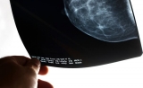 山东大学教授Oncologist发文：乳腺癌与肥胖的真正关联