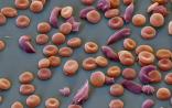 基因编辑技术有望治疗镰状细胞病 | Science Translational Medicine