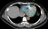 颠覆认知！NEJM：立体定向放疗竟能缓解顽固心律失常