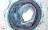 Science：衰老细胞伤害心脏？
