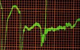 NEJM：年轻人心脏性猝死与基因有关
