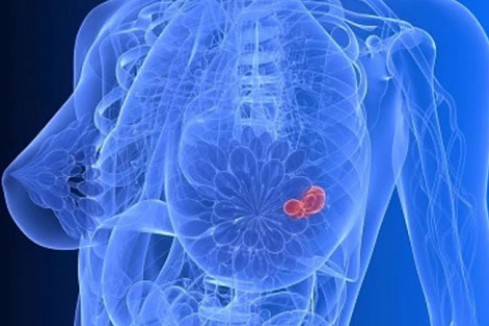 乳腺癌怎么治疗？分型施治才能提高疗效