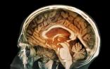 PNAS：脑子进“霾”易患老年痴呆，是有科学依据的