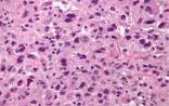 2016 ASCO：免疫疗法或可有效治疗特殊类型的肉瘤患者