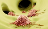 Science新发现打破常理：癌转移不需通过淋巴