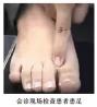 中美联合视频会诊，成就足部运动损伤患者的康复之梦！