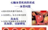 未来10年，你的心脑血管病风险是多少？