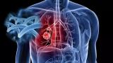 全新解读：精准医疗时代下的肺癌研究