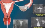 NEJM：40%的不孕女性或不用做试管婴儿，已经100岁的子宫输卵管造影术也可解决