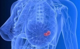 2017年最新乳腺癌筛查指南更新了！触诊自查是没有用的……