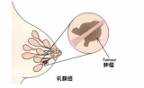 林奇综合征的基因研究发现了两种新的乳腺癌基因