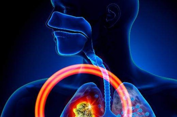 科学发现潜在肺癌早期诊断标志物，有望降低肺癌死亡率